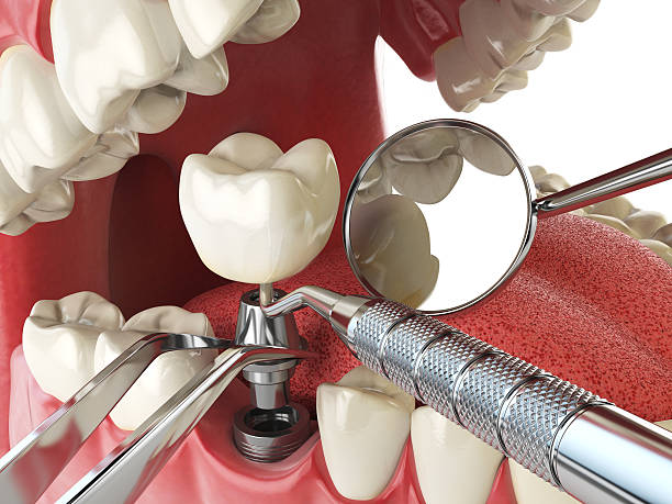 Best Emergency Root Canal Treatment in Brookhaven, MS